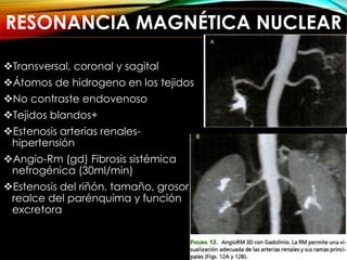 RESONANCIA MAGNÉTICA NUCLEAR
Transversal, coronal y sagital
Átomos de hidrogeno en los tejidos
No contraste endovenoso
Tejidos blandos+
Estenosis arterias renales-
hipertensión
Angio-Rm (gd) Fibrosis sistémica
nefrogénica (30ml/min)
Estenosis del riñón, tamaño, grosor,
realce del parénquima y función
excretora
 