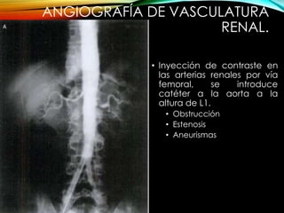 ANGIOGRAFÍA DE VASCULATURA
RENAL.
• Inyección de contraste en
las arterias renales por vía
femoral, se introduce
catéter a la aorta a la
altura de L1.
• Obstrucción
• Estenosis
• Aneurismas
 