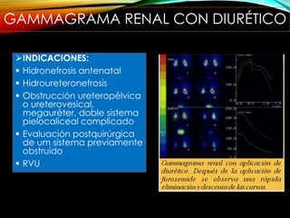 GAMMAGRAMA RENAL CON DIURÉTICO
INDICACIONES:
 Hidronefrosis antenatal
 Hidroureteronefrosis
 Obstrucción ureteropélvica
o ureterovesical,
megauréter, doble sistema
pielocaliceal complicado
 Evaluación postquirúrgica
de um sistema previamente
obstruído
 RVU
 