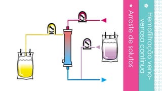 Arrastedesolutos
CVVH-Hemofiltração
Hemofiltraçãoveno-
venosacontínua
 