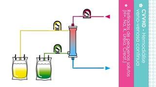 Retiradasdepequenossolutos
(H+,Na,K,Uréia,Creat.)
CVVHD-Hemodiálise
veno-venosacontinua
 