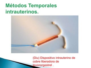 (Diu) Dispositivo intrauterino de
cobre liberadora de
levonorgestrel .
 
