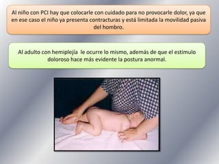 Al niño con PCI hay que colocarle con cuidado para no provocarle dolor, ya que
en ese caso el niño ya presenta contracturas y está limitada la movilidad pasiva
del hombro.

Al adulto con hemiplejía le ocurre lo mismo, además de que el estimulo
doloroso hace más evidente la postura anormal.

 