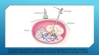 A schematic representation of fetoscopic laser photocoagulation for twin-twin transfusion
syndrome. A fetoscope is percutaneously inserted into the recipient sac through a cannula.
 