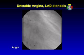 Unstable Angina, LAD stenosis
Angio
 