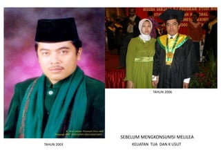 TAHUN 2006
TAHUN 2003
SEBELUM MENGKONSUMSI MELILEA
KELIATAN TUA DAN K USUT
 