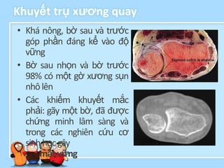 Khuyết trụ xƣơng quay
• Khá nông, bờ sau và trước
  góp phần đáng kể vào độ
  vững
• Bờ sau nhọn và bờ trước
  98% có một gờ xương sụn
  nhô lên
• Các khiếm khuyết mắc
  phải: gãy một bờ, đã được
  chứng minh lâm sàng và
  trong các nghiên cứu cơ
  sinh học gây
      mất vững
 