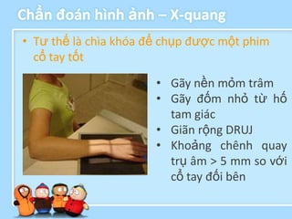 Chẩn đoán hình ảnh – X-quang
• Tư thế là chìa khóa để chụp được một phim
  cổ tay tốt

                       • Gãy nền mỏm trâm
                       • Gãy đốm nhỏ từ hố
                         tam giác
                       • Giãn rộng DRUJ
                       • Khoảng chênh quay
                         trụ âm > 5 mm so với
                         cổ tay đối bên
 