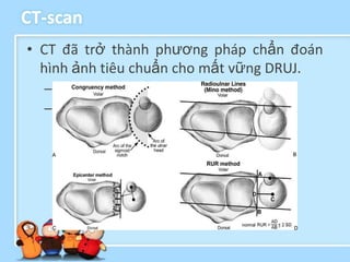 CT-scan
• CT đã trở thành phương pháp chẩn đoán
  hình ảnh tiêu chuẩn cho mất vững DRUJ.
  – Hai bên
  – Mất vững kín đáo
 