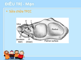 ĐIỀU TRỊ - Mạn
• Sửa chữa TFCC
 