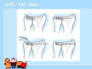 ĐIỀU TRỊ - Mạn
 