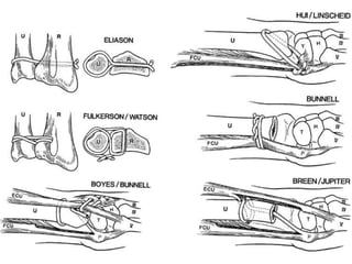 • Không sữa chữa đƣợc TFCC => Tái tạo

  – Buộc trực tiếp xương quay trụ ngoài khớp
  – Liên kết gián tiếp bằng cách treo qua dây
    chằng trụ cổ tay hoặc đính gân
  – Tái tạo dây chằng quay trụ dưới
 