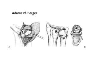 Adams và Berger
 