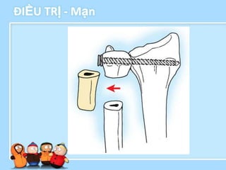 ĐIỀU TRỊ - Mạn
 