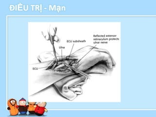 ĐIỀU TRỊ - Mạn
 