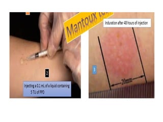 Montex Test Inj mtx test medicine mbbs presentation.pptx