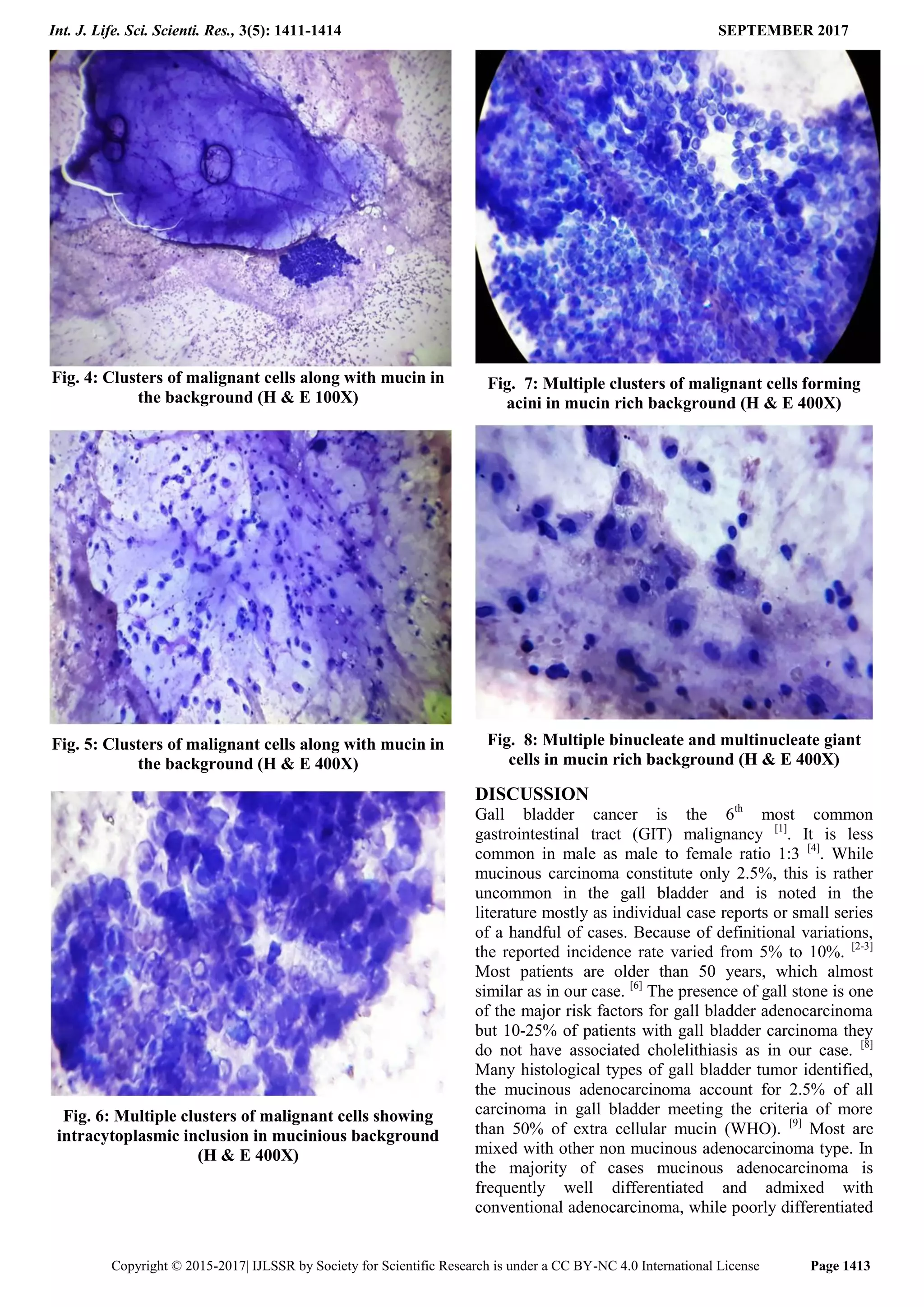 Mucinous Carcinoma of Gall Bladder an Incidental Finding of a Rare Case ...