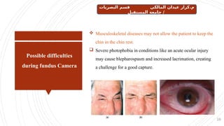 Possible difficulties
during fundus Camera
10
 Musculoskeletal diseases may not allow the patient to keep the
chin in the chin rest.
 Severe photophobia in conditions like an acute ocular injury
may cause blepharospasm and increased lacrimation, creating
a challenge for a good capture.
‫البصريات‬ ‫قسم‬ ‫المالكي‬ ‫عيدان‬ ‫كرار‬.‫م‬
‫المستقبل‬ ‫جامعة‬ /
 