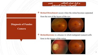 Diagnosis of Fundus
Camera
6
 Retinal Detachment occurs when the retina becomes separated
from the rest of the layers of the eye.
 Retinoblastoma is a disease in which malignant (cancer) cells
form in the tissues of the retina.
‫قسم‬ ‫المالكي‬ ‫عيدان‬ ‫كرار‬.‫م‬
‫المستقبل‬ ‫جامعة‬ / ‫البصريات‬
 