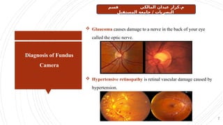 Diagnosis of Fundus
Camera
7
 Glaucoma causes damage to a nerve in the back of your eye
called the optic nerve.
 Hypertensive retinopathy is retinal vascular damage caused by
hypertension.
‫قسم‬ ‫المالكي‬ ‫عيدان‬ ‫كرار‬.‫م‬
‫المستقبل‬ ‫جامعة‬ / ‫البصريات‬
 