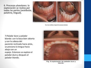 6. Procesos alveolares: la
exploración se realiza por
todas las partes (vestibular,
palatino, lingual).
7.Paladar duro y paladar
blando: con la boca bien abierta
y con la cabeza del
paciente reclinada hacia atrás,
se presiona la lengua hacia
abajo con un
espejo. Entonces se explora el
paladar duro y después el
paladar blando.
 