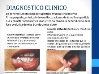 DIAGNOSTICO CLINICO
En general:tumefaccion de superficie mucosa(crecimiento
firme,pequeño,esferico,indoloro,fluctuaciones de tamaño,superficie
lisa y carácter recidivante) «consistencia cambiara dependiendo de la
fase evolutiva de mas blando a mas duro»
Lesión superficial :aparece como
una vesícula levantada de varios
milímetros a 1 o 2 cm de diá-
metro con una coloración azul
translucente
Lesiones profundas: también se manifiestan
como
inflamación, pero en la superficie la
coloración es normal
debido al espesor de los tejidos que la
cubren . El quiste se desarrolla usualmente
en pocos días y persiste a menos que sean
tratados.
 