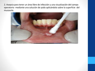 2. Asepsia para tener un área libre de infección y una visualización del campo
operatorio mediante una solución de yodo aplicándola sobre la superficie del
mucocele.
 
