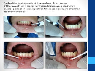 3.Administración de anestesia tópica en cada uno de los puntos a
infiltrar, como lo son el agujero mentoniano localizado entre el primero y
segundo premolar en sentido apical y en fondo de saco de la parte anterior en
los incisivos inferiores
 