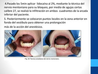 4.Pasado los 5min aplicar lidocaína al 2%, mediante la técnica del
nervio mentoniano para su bloqueo, por medio de agujas cortas
calibre 27, se realizó la infiltración en ambos cuadrantes de la arcada
inferior del paciente.
5. Posteriormente se colocaron puntos locales en la zona anterior en
fondo del vestíbulo para obtener una prolongación
más de la acción del anestésico.
 