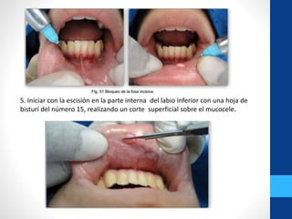 5. Iniciar con la escisión en la parte interna del labio inferior con una hoja de
bisturí del número 15, realizando un corte superficial sobre el mucocele.
 