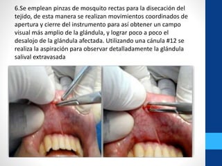 6.Se emplean pinzas de mosquito rectas para la disecación del
tejido, de esta manera se realizan movimientos coordinados de
apertura y cierre del instrumento para así obtener un campo
visual más amplio de la glándula, y lograr poco a poco el
desalojo de la glándula afectada. Utilizando una cánula #12 se
realiza la aspiración para observar detalladamente la glándula
salival extravasada
 