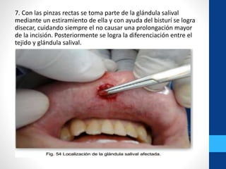 7. Con las pinzas rectas se toma parte de la glándula salival
mediante un estiramiento de ella y con ayuda del bisturí se logra
disecar, cuidando siempre el no causar una prolongación mayor
de la incisión. Posteriormente se logra la diferenciación entre el
tejido y glándula salival.
 