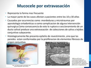 • Representa la forma mas frecuente
• La mayor parte de los casos afectan a pacientes entre los 10 y 30 años
• Causados por ocurrencias como :mordeduras y microtraumas por
aparatologia ortodonticas o como complicacion de alguna intervención
quirurgica.Como consecuencia de esto la ruptura o seccionamiento de un
ducto salival produce una extravasación de colecciones de saliva a tejidos
conjuntivo subyacente.
• Histologicamente:No presenta epitelio de revestimiento ,sino que las
paredes estan conformadas por la proliferacion de elementos fibrosos de
origen conjuntivo.
Mucocele por extravasación
 