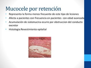 Mucocele por retención
• Representa la forma menos frecuente de este tipo de lesiones
• Afecta a pacientes con frecuencia en pacientes con edad avanzada
• Acumulación de sialomucina ocurre por obstruccion del conducto
excretor
• Histologia:Revestimiento epitelial
 
