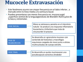 Mucocele Extravasación
• Este fenómeno ocurre con mayor frecuencia en el labio inferior , a
menudo entre la linea media y la comisura bucal.
• Pueden presentarse con menor frecuencia en: mucosa yugal
,superficie ventral de la lengua(glandulas de Blanddin-Nuhn),piso de
la boca y retromolar.
Moco se extravasa y penetra en el intersticio
tubular .Se produce una respuesta inflamatoria
leucocitaria y linfocitaria que trata de
circunscribir el proceso
Se desarrolla un «granuloma mucoso» con
contenido de histiocitos y macrofagos
espumosos cargados de moco junto a células
multinucleadas de cuerpo extraño.
Se desarrolla un quiste mucinosocon una
pseudocapsula conectiva alrededor
FASE INICIAL
FASE DE
REABSORCION
FASE FINAL
 