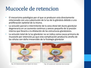 Mucocele UPAO Dr Fonseca PPTX Mucocele UPAO Dr Fonseca PPTX