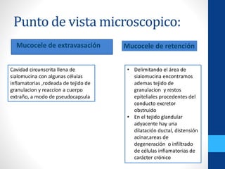 Punto de vista microscopico:
Mucocele de extravasación
Cavidad circunscrita llena de
sialomucina con algunas células
inflamatorias ,rodeada de tejido de
granulacion y reaccion a cuerpo
extraño, a modo de pseudocapsula
Mucocele de retención
• Delimitando el área de
sialomucina encontramos
ademas tejido de
granulacion y restos
epiteliales procedentes del
conducto excretor
obstruido
• En el tejido glandular
adyacente hay una
dilatación ductal, distensión
acinar,areas de
degeneración o infiltrado
de células inflamatorias de
carácter crónico
 