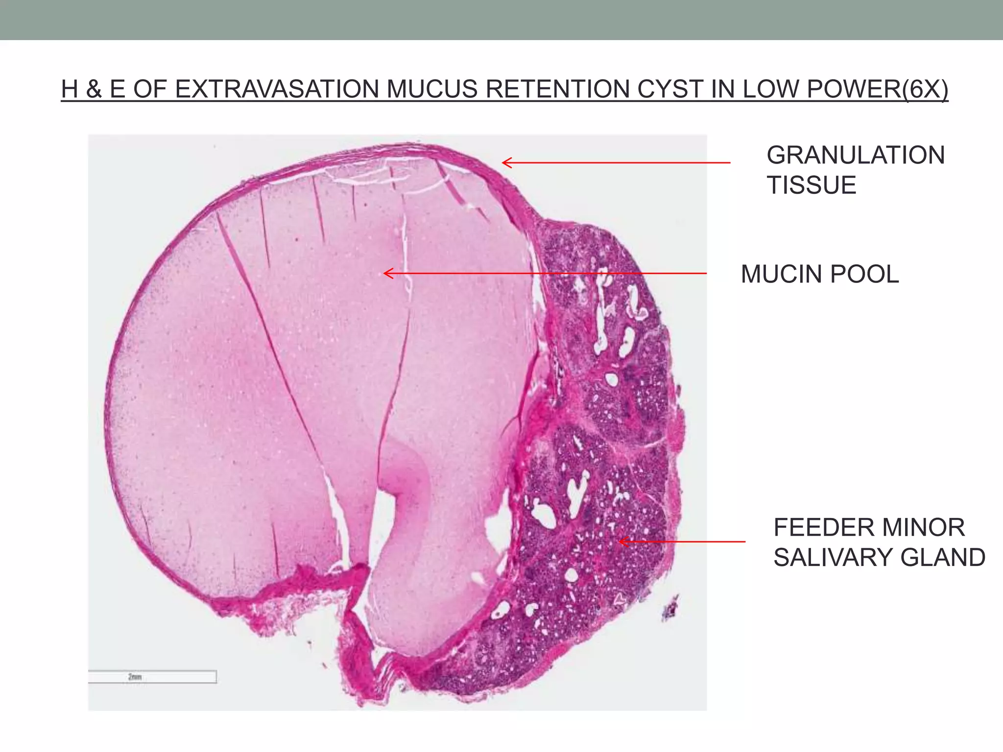 Mucell Section Mucocele | PPTX