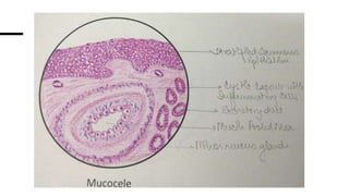 Mucell Section Mucocele Histology Diagram