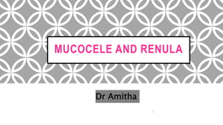 MUCOCELE AND RENULA
Dr Amitha
 
