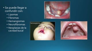 lipoma
fibroma
hemangioma
 