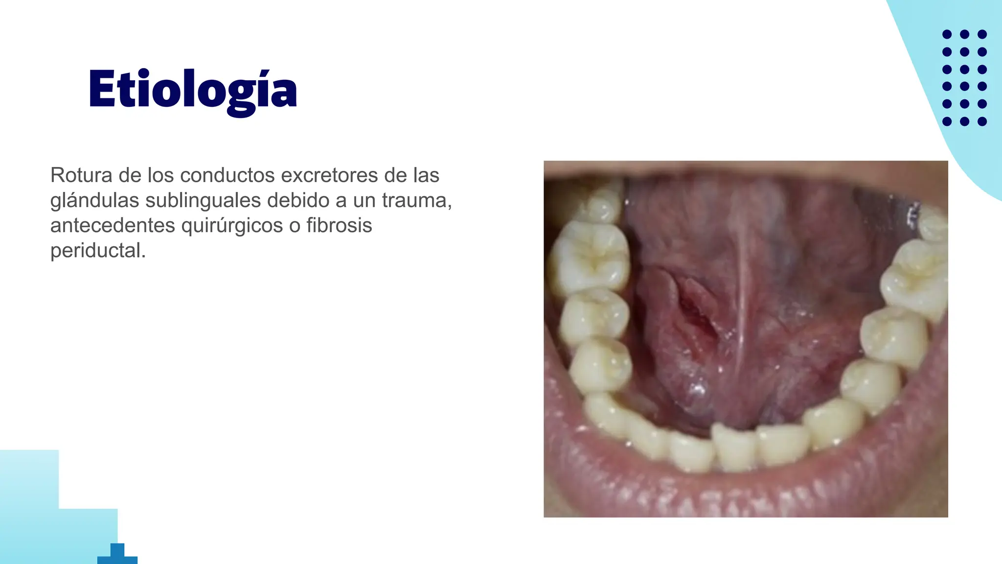 Mucocele, Ranula, Parotiditis, Sx de Sjogren.pdf