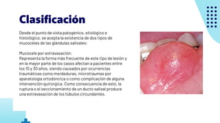 Mucocele, Ranula, Parotiditis, Sx de Sjogren.pdf