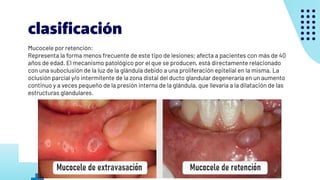 Mucocele Ranula Parotiditis Sx De Sjogren pdf Mucocele Ranula Parotiditis Sx De Sjogren pdf