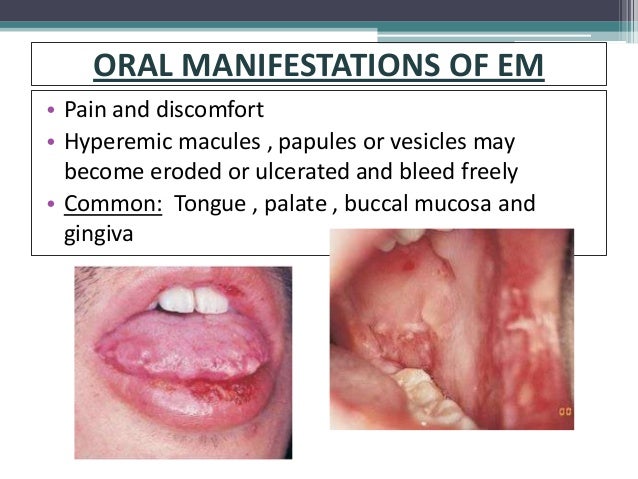 Mucusum Rash Mucocutaneous