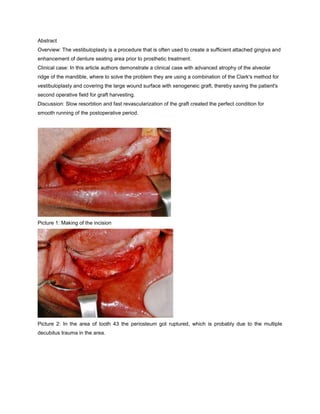 Abstract
Overview: The vestibuloplasty is a procedure that is often used to create a sufficient attached gingiva and
enhancement of denture seating area prior to prosthetic treatment.
Clinical case: In this article authors demonstrate a clinical case with advanced atrophy of the alveolar
ridge of the mandible, where to solve the problem they are using a combination of the Clark's method for
vestibuloplasty and covering the large wound surface with xenogeneic graft, thereby saving the patient's
second operative field for graft harvesting.
Discussion: Slow resorbtion and fast revascularization of the graft created the perfect condition for
smooth running of the postoperative period.
Picture 1: Making of the incision
Picture 2: In the area of tooth 43 the periosteum got ruptured, which is probably due to the multiple
decubitus trauma in the area.
 
