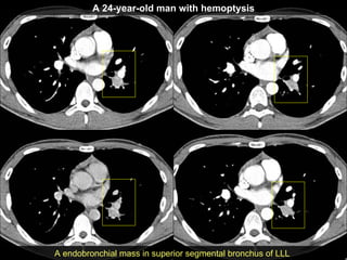 A 24-year-old man with hemoptysis A endobronchial mass in superior segmental bronchus of LLL 