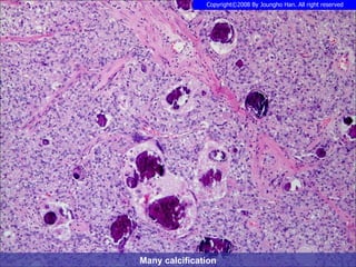 Many calcification 