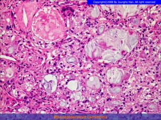 Mucoepidermoid carcinoma 