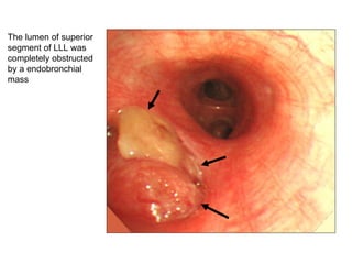 The lumen of superior segment of LLL was completely obstructed by a endobronchial mass 